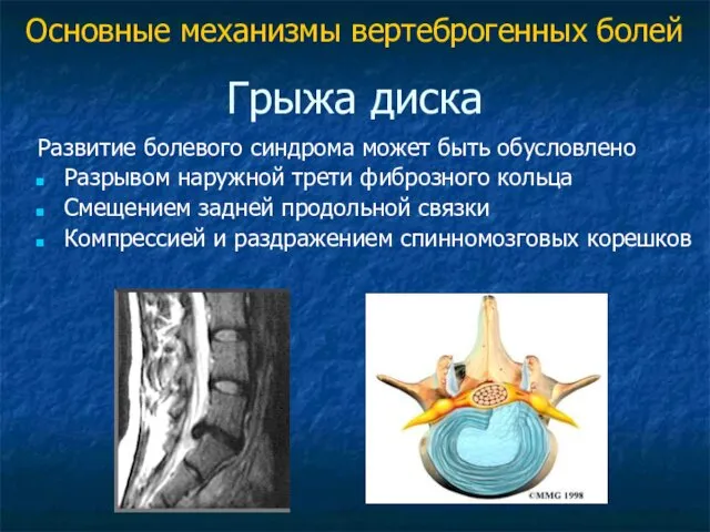 Грыжа диска Развитие болевого синдрома может быть обусловлено Разрывом наружной трети