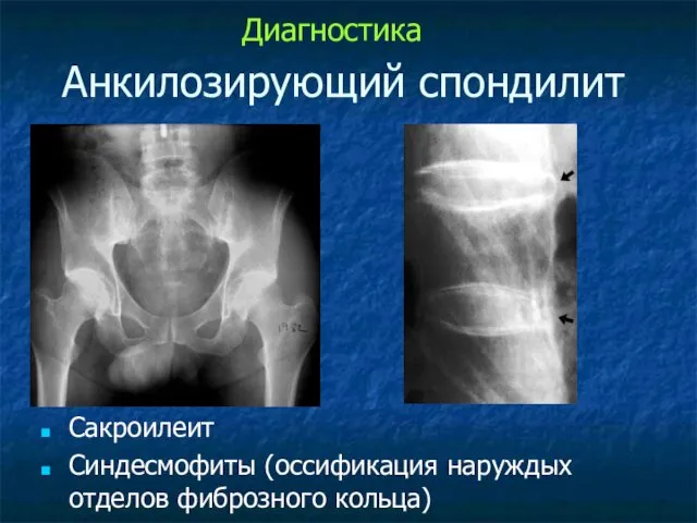 Анкилозирующий спондилит Сакроилеит Синдесмофиты (оссификация наруждых отделов фиброзного кольца) Диагностика