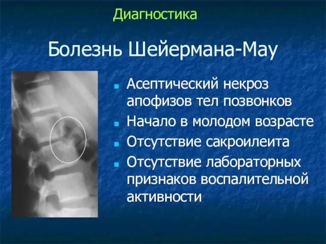 Болезнь Шейермана-Мау Асептический некроз апофизов тел позвонков Начало в молодом возрасте