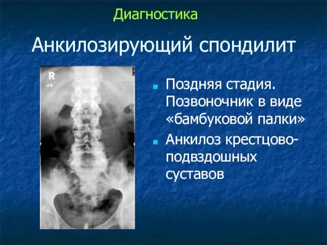 Анкилозирующий спондилит Поздняя стадия. Позвоночник в виде «бамбуковой палки» Анкилоз крестцово-подвздошных суставов Диагностика