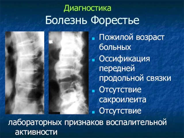 Болезнь Форестье Пожилой возраст больных Оссификация передней продольной связки Отсутствие сакроилеита