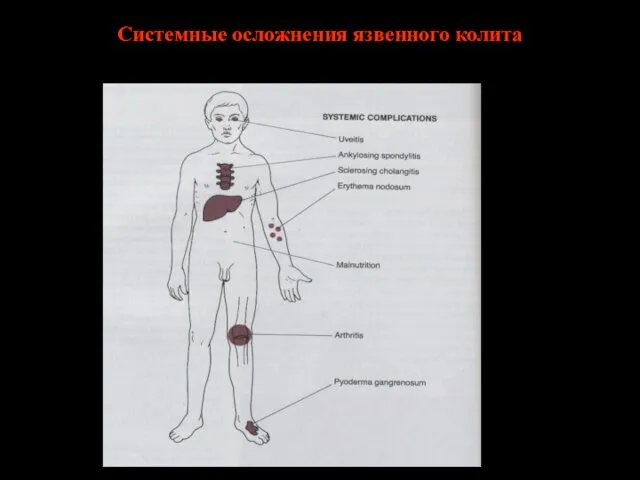 Системные осложнения язвенного колита