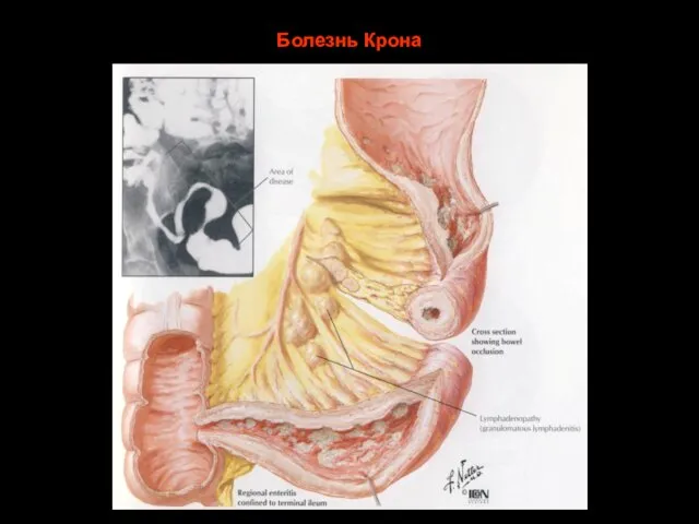 Болезнь Крона