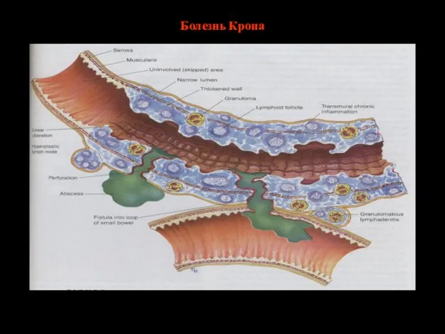 Болезнь Крона