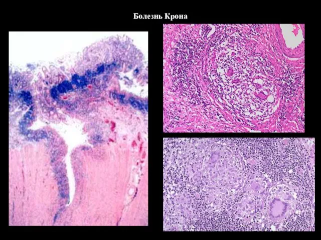 Болезнь Крона