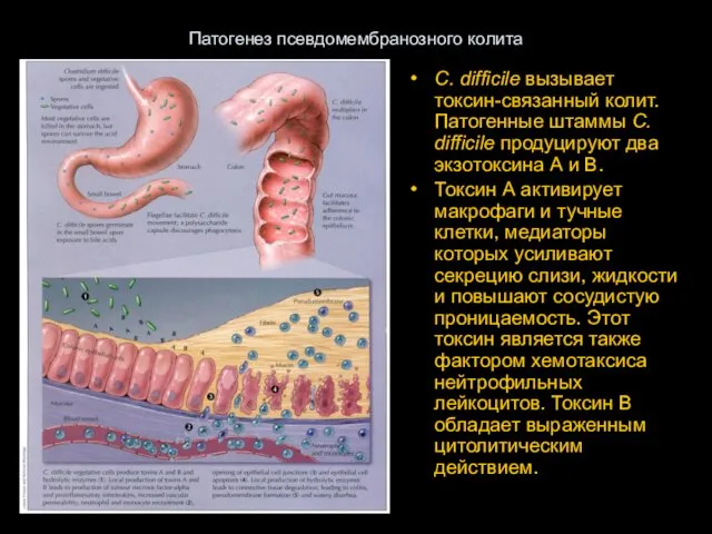 Патогенез псевдомембранозного колита C. difficile вызывает токсин-связанный колит. Патогенные штаммы C.