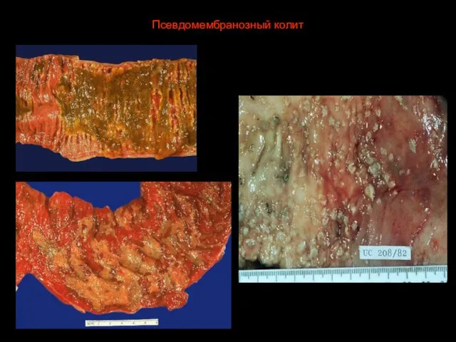 Псевдомембранозный колит