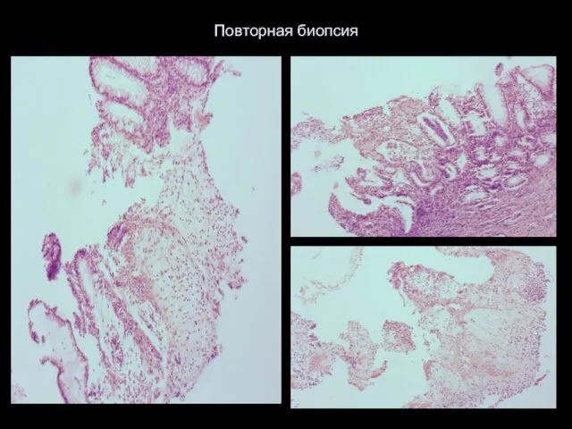 Повторная биопсия