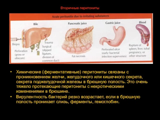 Вторичные перитониты Химические (ферментативные) перитониты связаны с проникновением желчи, желудочного или