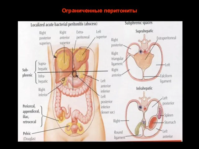 Ограниченные перитониты