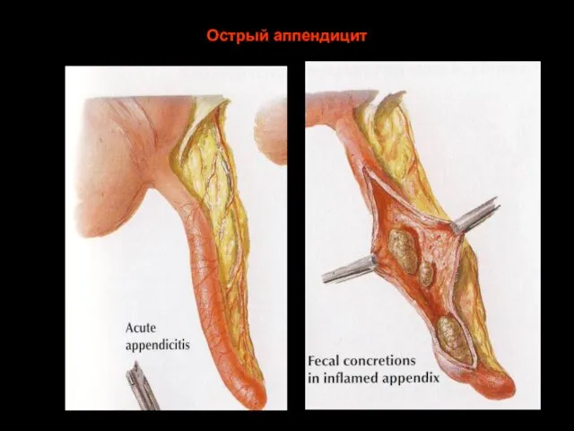 Острый аппендицит