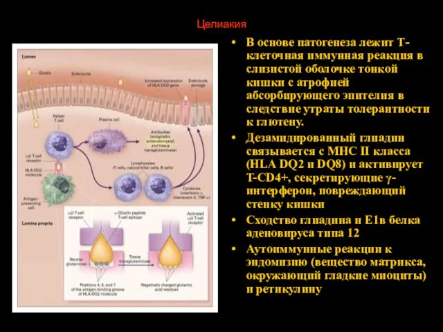 Целиакия В основе патогенеза лежит Т-клеточная иммунная реакция в слизистой оболочке