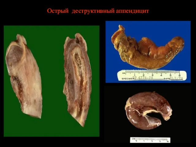 Острый деструктивный аппендицит