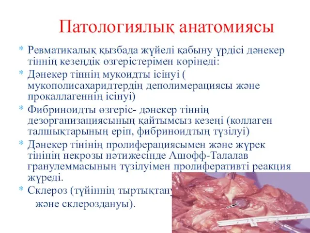 Ревматикалық қызбада жүйелі қабыну үрдісі дәнекер тіннің кезеңдік өзгерістерімен көрінеді: Дәнекер