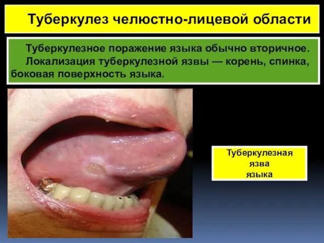 Туберкулезное поражение языка обычно вторичное. Локализация туберкулезной язвы — корень, спинка,