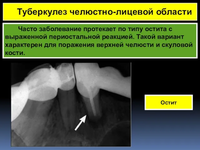 Часто заболевание протекает по типу остита с выраженной периостальной реакцией. Такой