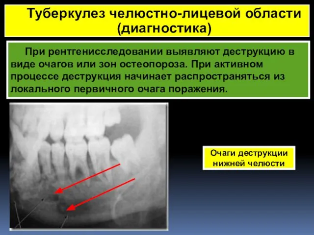 При рентгенисследовании выявляют деструкцию в виде очагов или зон остеопороза. При