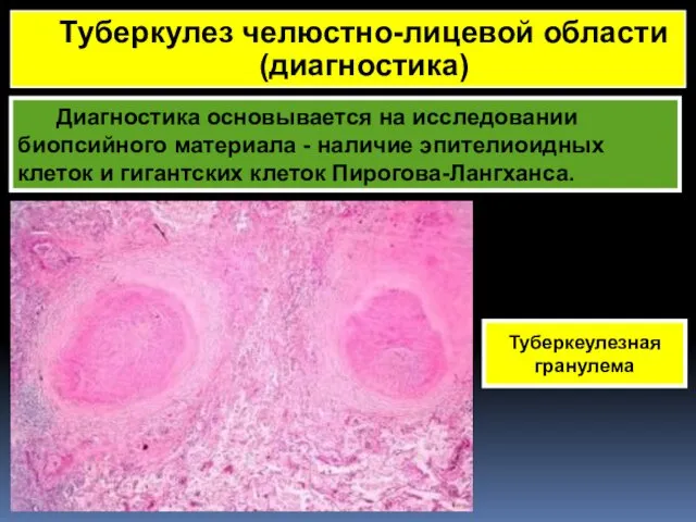 Диагностика основывается на исследовании биопсийного материала - наличие эпителиоидных клеток и