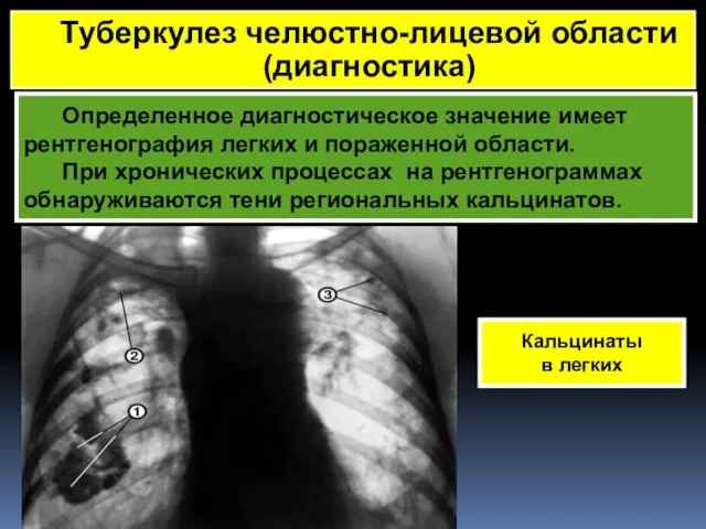 Определенное диагностическое значение имеет рентгенография легких и пораженной области. При хронических