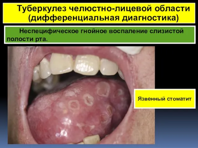 Неспецифическое гнойное воспаление слизистой полости рта. Туберкулез челюстно-лицевой области (дифференциальная диагностика) Язвенный стоматит