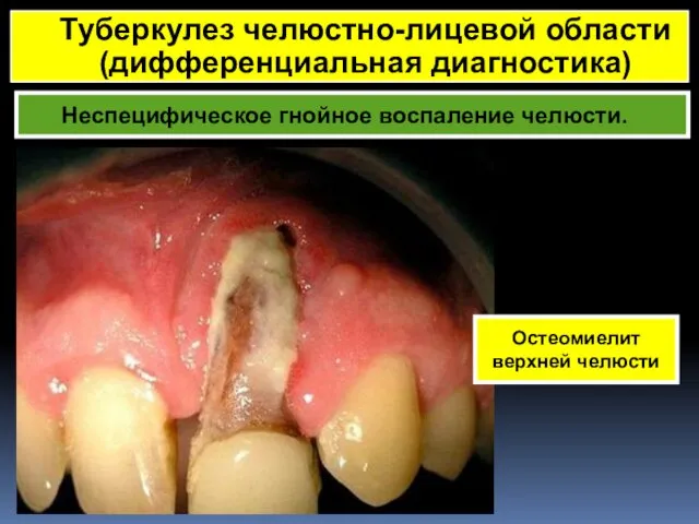 Неспецифическое гнойное воспаление челюсти. Туберкулез челюстно-лицевой области (дифференциальная диагностика) Остеомиелит верхней челюсти