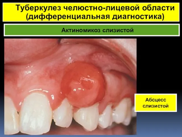 Актиномикоз слизистой Туберкулез челюстно-лицевой области (дифференциальная диагностика) Абсцесс слизистой