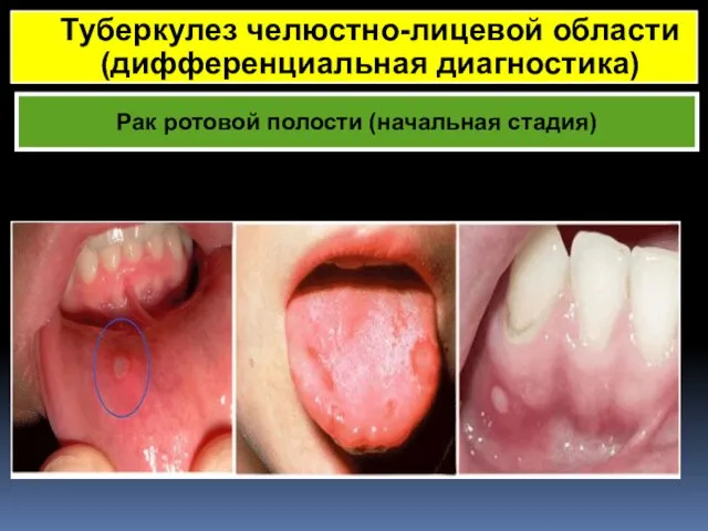 Рак ротовой полости (начальная стадия) Туберкулез челюстно-лицевой области (дифференциальная диагностика)