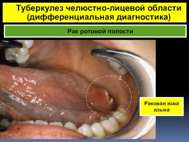 Рак ротовой полости Туберкулез челюстно-лицевой области (дифференциальная диагностика) Раковая язва языка