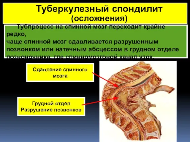 Тубпроцесс на спинной мозг переходит крайне редко, чаще спинной мозг сдавливается