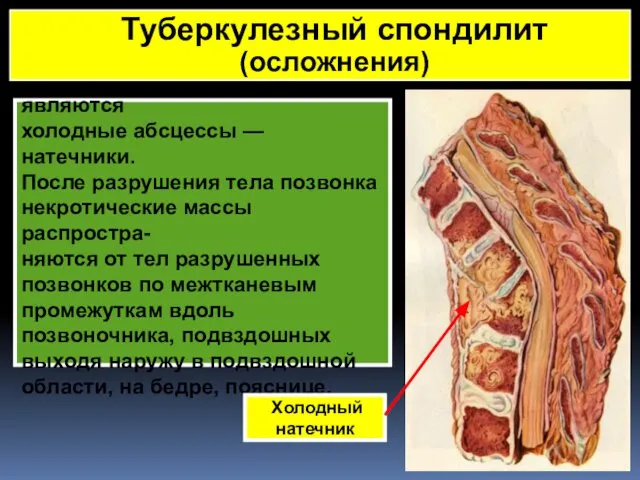 Частым осложнением являются холодные абсцессы — натечники. После разрушения тела позвонка