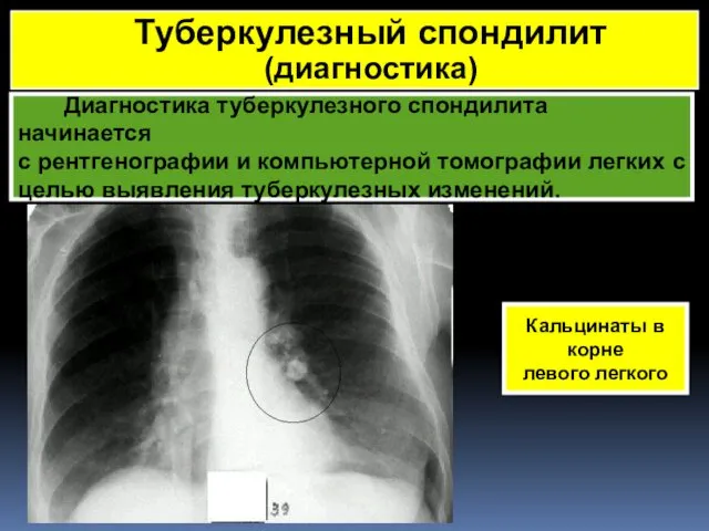 Диагностика туберкулезного спондилита начинается с рентгенографии и компьютерной томографии легких с