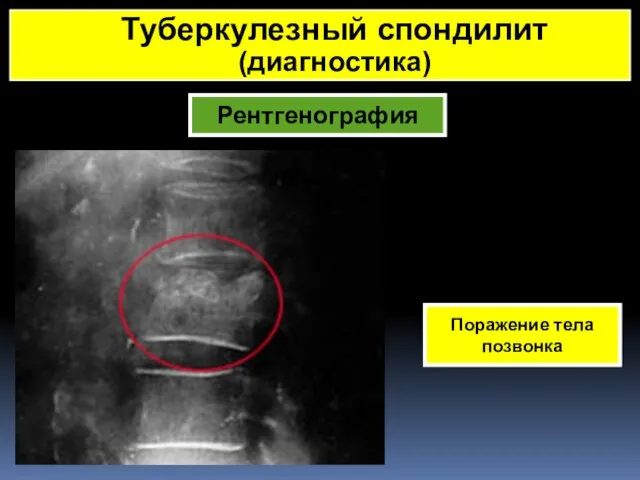 Рентгенография Поражение тела позвонка Туберкулезный спондилит (диагностика)