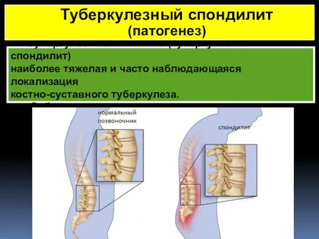 Туберкулез позвоночника (туберкулезный спондилит) наиболее тяжелая и часто наблюдающаяся локализация костно-суставного