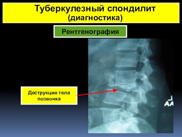 Рентгенография Деструкция тела позвонка Туберкулезный спондилит (диагностика)