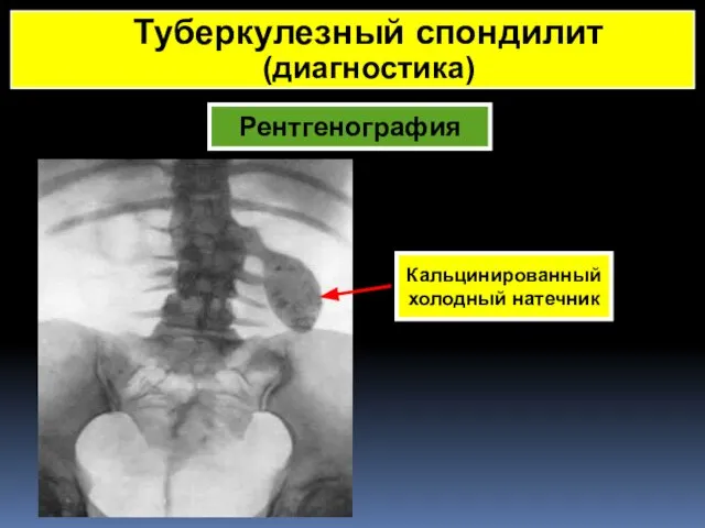 Рентгенография Кальцинированный холодный натечник Туберкулезный спондилит (диагностика)