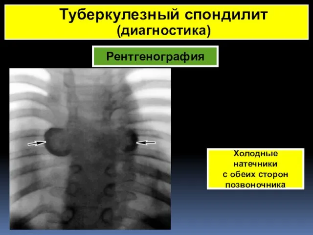 Рентгенография Холодные натечники с обеих сторон позвоночника Туберкулезный спондилит (диагностика)