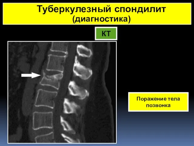 КТ Поражение тела позвонка Туберкулезный спондилит (диагностика)