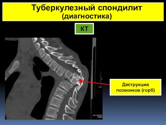 КТ Деструкция позвонков (горб) Туберкулезный спондилит (диагностика)