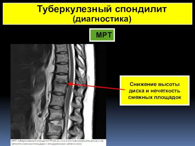 МРТ Снижение высоты диска и нечеткость смежных площадок Туберкулезный спондилит (диагностика)