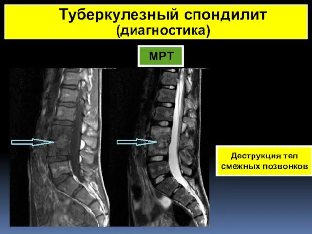 МРТ Деструкция тел смежных позвонков Туберкулезный спондилит (диагностика)