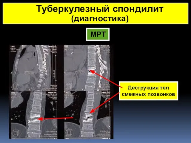 МРТ Деструкция тел смежных позвонков Туберкулезный спондилит (диагностика)