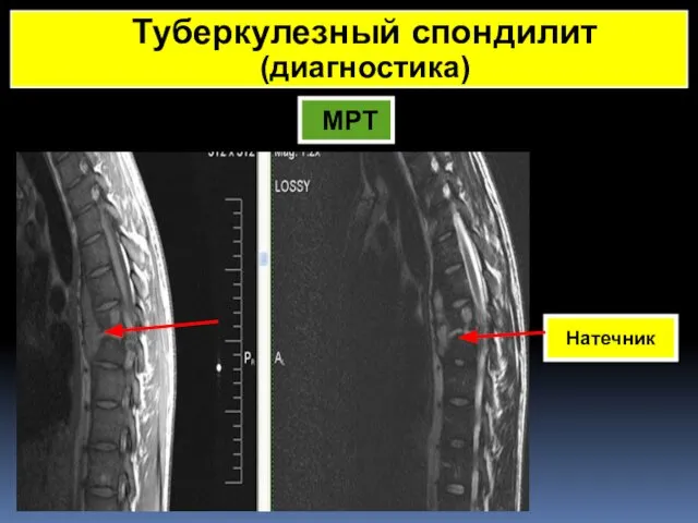 МРТ Туберкулезный спондилит (диагностика) Натечник