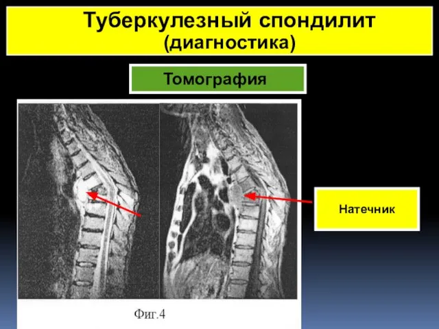 Томография Натечник Туберкулезный спондилит (диагностика)