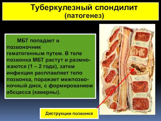 МБТ попадает в позвоночник гематогенным путем. В теле позвонка МБТ растут