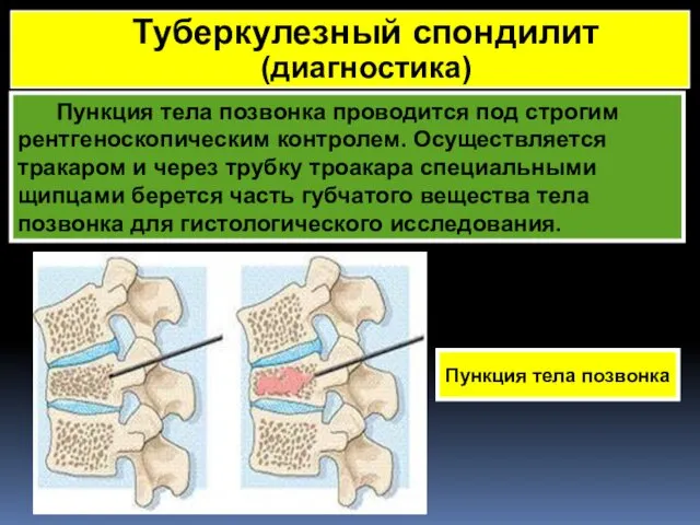 Пункция тела позвонка проводится под строгим рентгеноскопическим контролем. Осуществляется тракаром и