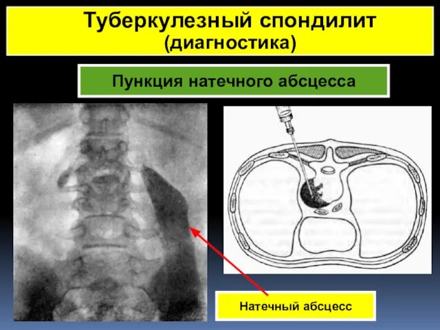 Пункция натечного абсцесса Натечный абсцесс Туберкулезный спондилит (диагностика)