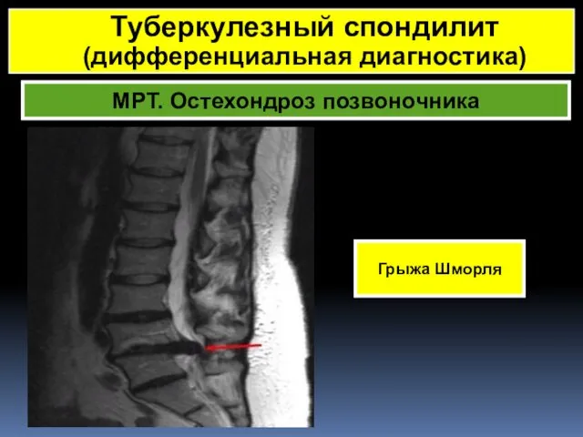 МРТ. Остехондроз позвоночника Грыжа Шморля Туберкулезный спондилит (дифференциальная диагностика)