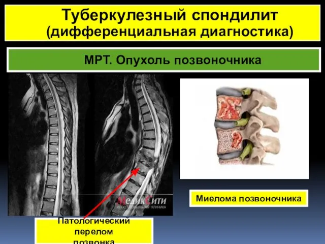 МРТ. Опухоль позвоночника Миелома позвоночника Туберкулезный спондилит (дифференциальная диагностика) Патологический перелом позвонка