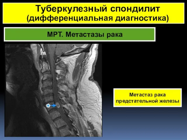 МРТ. Метастазы рака Метастаз рака предстательной железы Туберкулезный спондилит (дифференциальная диагностика)