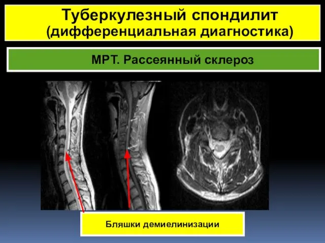 МРТ. Рассеянный склероз Туберкулезный спондилит (дифференциальная диагностика) Бляшки демиелинизации